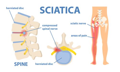 Sciatica Doctor Waldorf MD