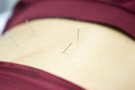 Dry Needling Waldorf MD